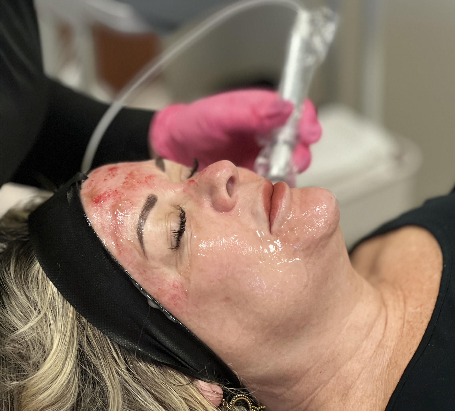 The Science Behind Exceed Microneedling: How It Stimulates Collagen and Revitalizes Skin